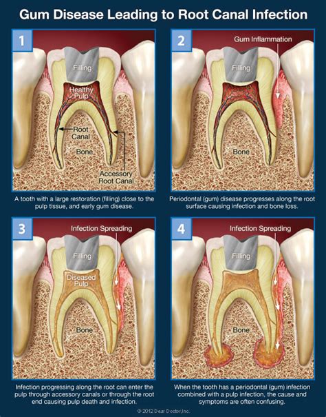 Why Does It Hurt Between My Teeth - TeethWalls