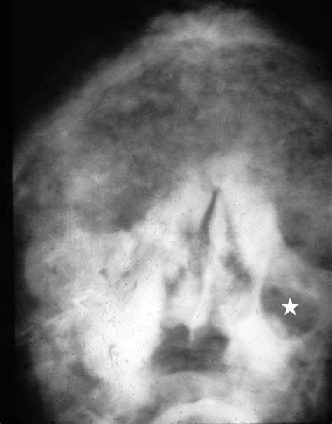 The Development And Pathologic Processes That Influence Maxillary Sinus