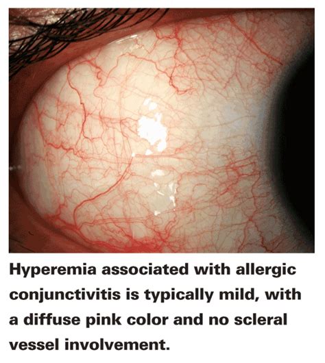 Conjunctival Hyperemia