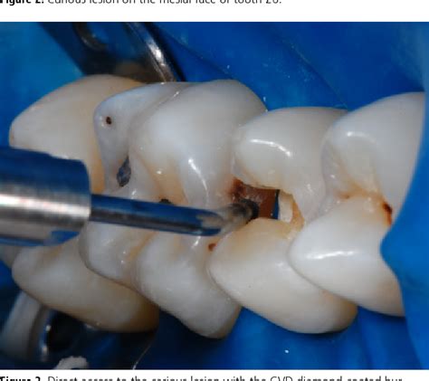 Figure 1 From Cavity Instrumentation With Chemical Vapor Deposition