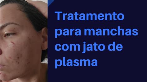 Tratamento Para Manchas Jato De Plasma YouTube