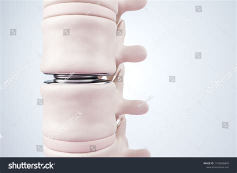 Illustration Intervertebral Disc Prosthesis Close View Stock Illustration 1145606849 | Shutterstock