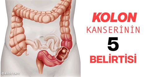 Erken Tespiti Halinde Kolon Kanserinden Kurtulmayı Sağlayan 5 Belirti