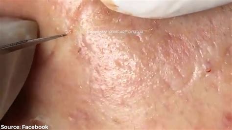 Treatment Of Acne Blackheads Ss01e03 Part 1 Youtube