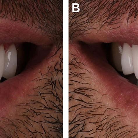 (A) Acceptable uniform buccal corridor. (B) The corridor is not uniform... | Download Scientific ...