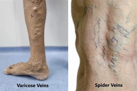 Varicose Vs Spider Veins Treatments By Dr Sumit Kapadia