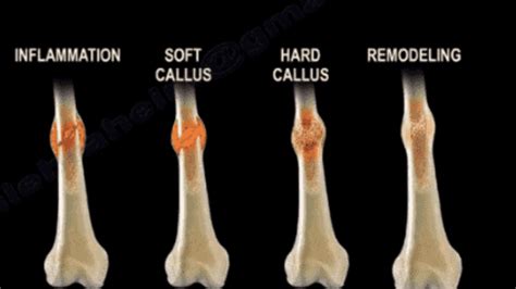 Broken Bones: Rebuilding From The Inside Out - Project Cleris