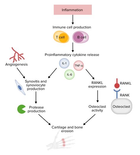 Artritis Reumatoide | Concise Medical Knowledge