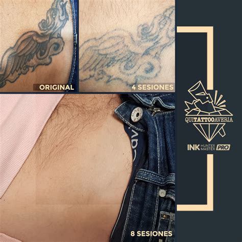 TATUAJES ANTES Y DESPUÉS SOMETER AL LÁSER QUITATTOOAVERIA