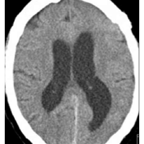 A Noncontrast Axial Computed Tomography Scan Of The Head Done On