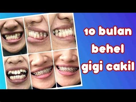 10 Bulan Perawatan Behel Gigi Cakil Menjadi Normal Gigi Cameh Dibehel