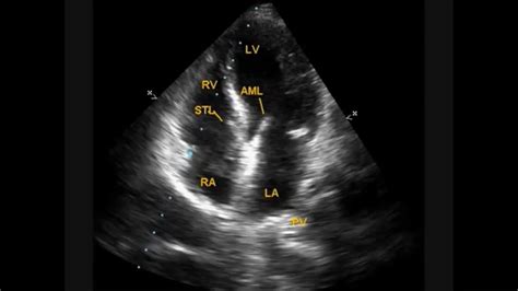 Mild Tricuspid Regurgitation Symptoms Doctorvisit