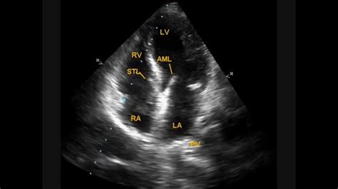 Mild Tricuspid Regurgitation Youtube