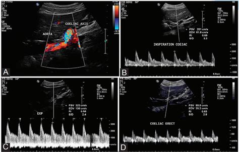 Real-time ultrasound: Key factor in identifying celiac artery compression syndrome