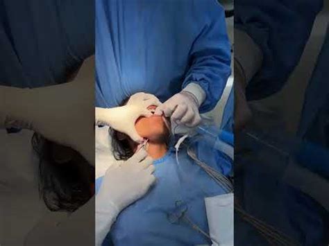 Submental Intubation Procedure YouTube