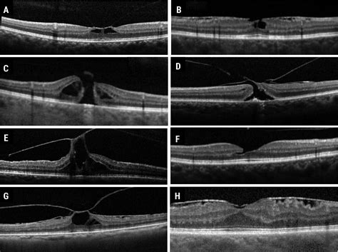 Epiretinal Membrane Oct