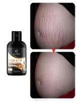 Buy Focufix Present Repair Stretch Marks Removal Natural Heal