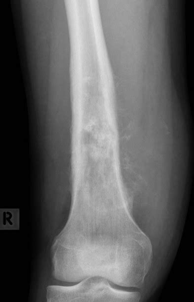 Conventional Osteosarcoma The Bone School