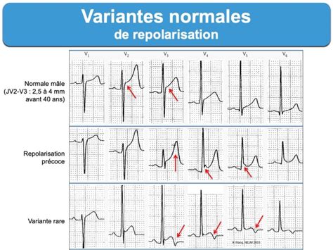 Repolarisation Masculine E Cardiogram