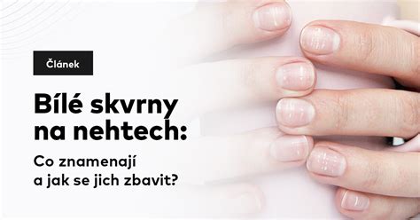 Bílé skvrny na nehtech Co znamenají a jak se jich zbavit