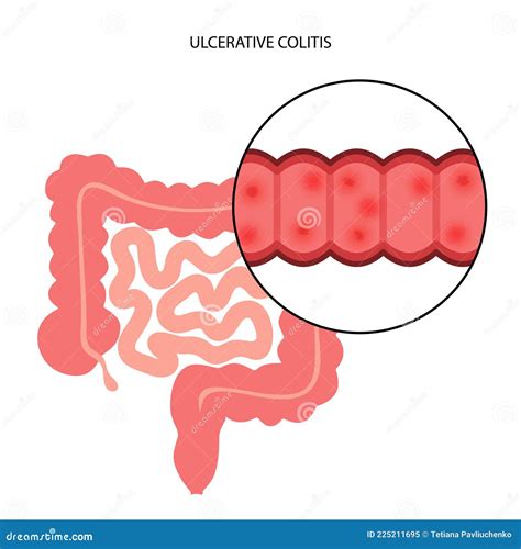 Intestine Ulcerative Colitis Stock Vector Illustration Of Intestine Inflammation 225211695