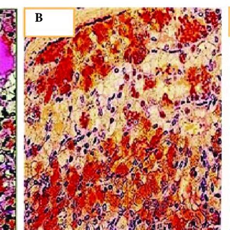 A A Case Of Acinic Cell Carcinoma Showing Moderate Positivity Of