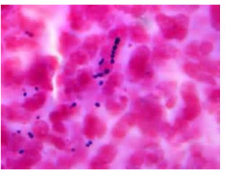 Streptococcus Pneumoniae Gram Stain Csf