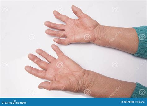 Hands With Rheumatoid Arthritis Royalty Free Stock Photo - Image: 28575825