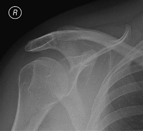 Avulsion Fracture Of The Coracoid Process Emergency Medicine Journal