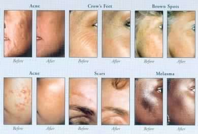 Diamond Microdermabrasion Estevan Laser Health Clinic