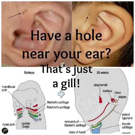 Branchial Cyst Ppt