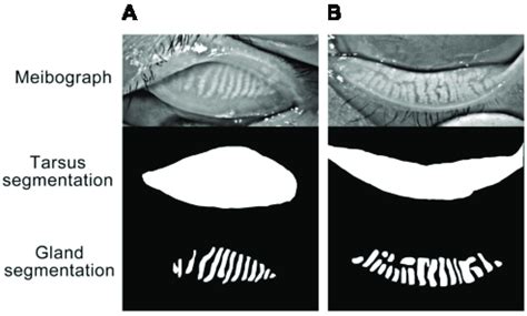 ab represented  upper eyelid   eyelid