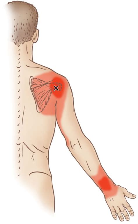 Subscapularis Trigger Point Learn Muscles