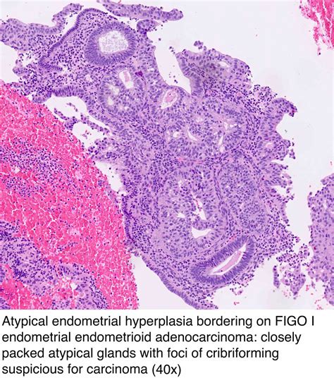 Pathology Outlines - Endometrial hyperplasia / endometrioid ...