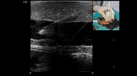 Ultrasound Guided Vascular Cannulation In Critical Care Patients A Practical Review Medicina