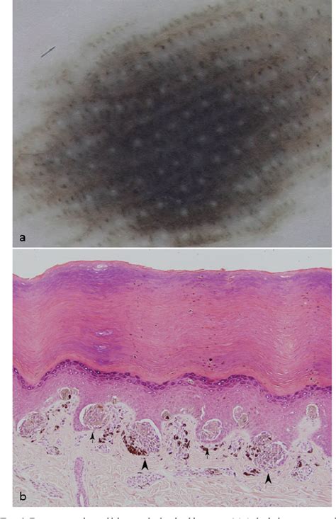 Figure 1 From Dermoscopic Characteristics Of Acquired Melanocytic