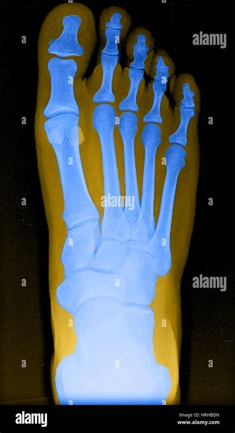 X Ray Normal Foot Hi Res Stock Photography And Images Alamy