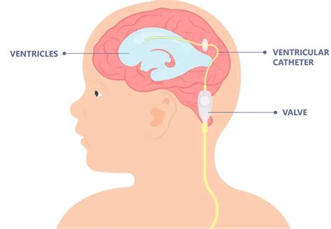 Chirurgie Shunt Ventriculoperitoneal VP