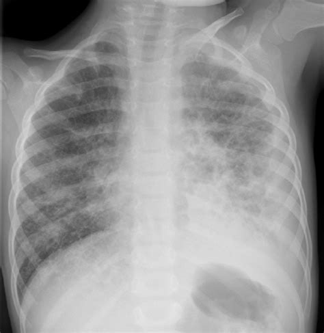 Chest Radiograph Performed Eight Weeks After Recovery Revealing