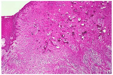 Ossifying Fibroma Histology Hot Sex Picture