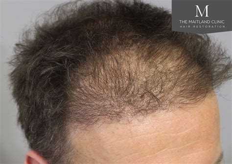 1611 Grafts Hair Transplant Repair Surgery The Maitland Clinic