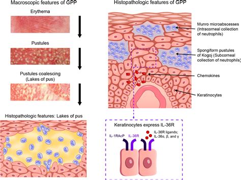 Frontiers The Role Of The Interleukin 36 Axis In Generalized Pustular