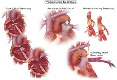 Atrial Septostomy 24 Download Scientific Diagram