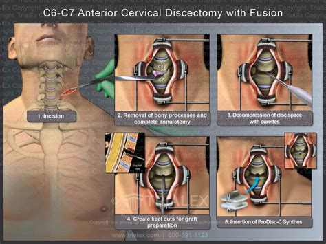 C C Anterior Cervical Discectomy With Fusion Trial Exhibits I