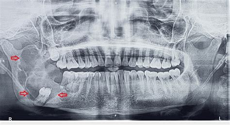 Multilocular Radiolucency In Right Mandibular Posterior Region