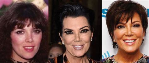 Kris Jenner Plastic Surgery Before And After Pictures 2024