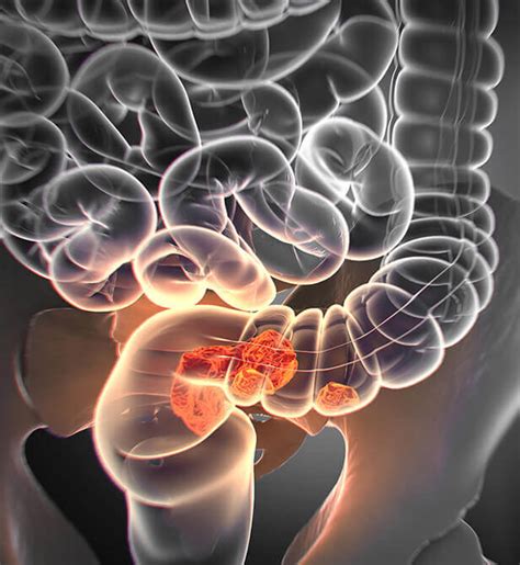 Stage IV Colon & Rectal Cancer - Thesurgeons