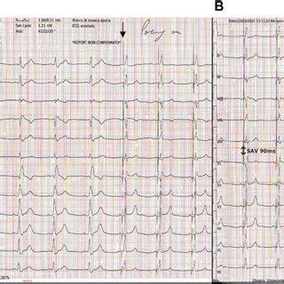 A Electrocardiogram Showing Normal Sinus Rhythm With Complete Right