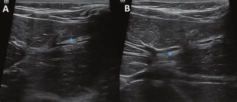 On further follow-up, USS (A, B) shows coarse echotexture of the liver... | Download Scientific ...