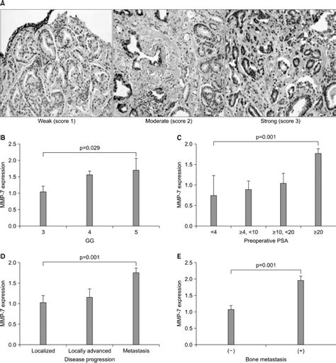 Expression Of Matrix Metalloproteinase 7 Mmp 7 Mmp 7 Was Expressed